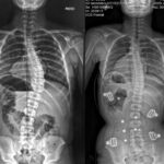 Scoliosis Bracing: Essential Education for Adolescent Patients